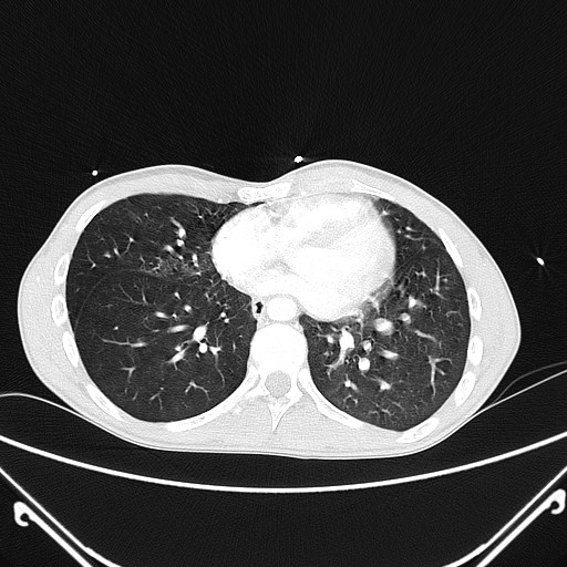 File:Alagille syndrome with pulmonary hypertension (Radiopaedia 49384-54980 Axial lung window 5).jpg