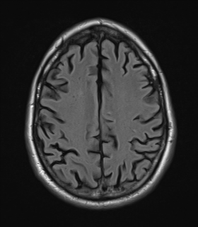 File:Alzheimer's disease- with Gerstmann syndrome and dressing apraxia (Radiopaedia 54882-61150 Axial FLAIR 21).png
