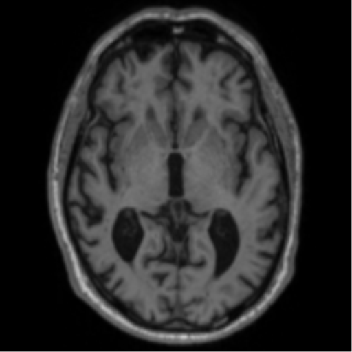 Alzheimer's disease- with Gerstmann syndrome and dressing apraxia (Radiopaedia 54882-61150 Axial T1 36).png