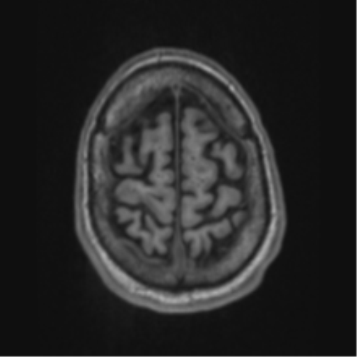 Alzheimer's disease- with apraxia (Radiopaedia 54763-61011 Axial T1 66).png