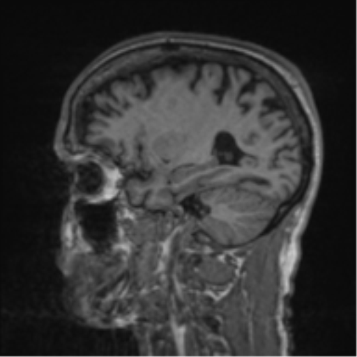 File:Alzheimer's disease- with apraxia (Radiopaedia 54763-61011 Sagittal T1 49).png