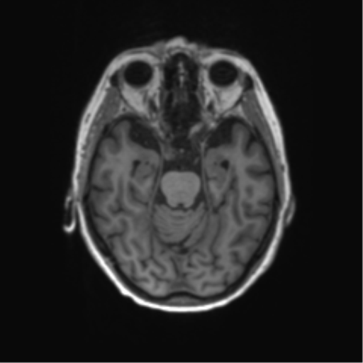 File:Alzheimer's disease (Radiopaedia 42658-45802 Axial T1 100).png