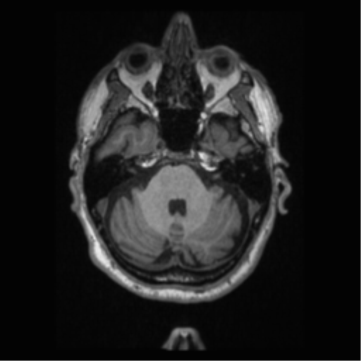 Alzheimer disease - probable (Radiopaedia 35334-36837 Axial T1 23).png