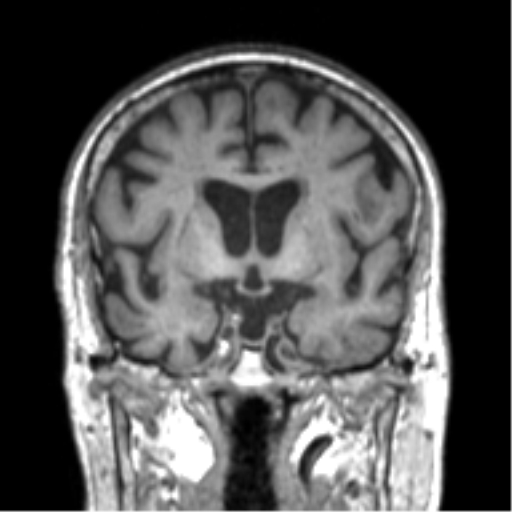 Alzheimer disease and cerebral amyloid angiopathy (Radiopaedia 64234-73011 Coronal T1 40).png