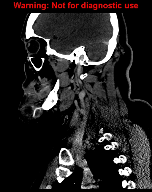 Ameloblastoma (Radiopaedia 33126-34164 F 49).jpg