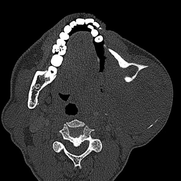Ameloblastoma (Radiopaedia 51921-57766 Axial bone window 75).jpg
