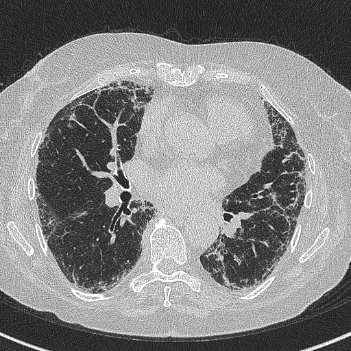 Amiodarone-induced pulmonary fibrosis (Radiopaedia 82355-96460 Axial lung window 38).jpg
