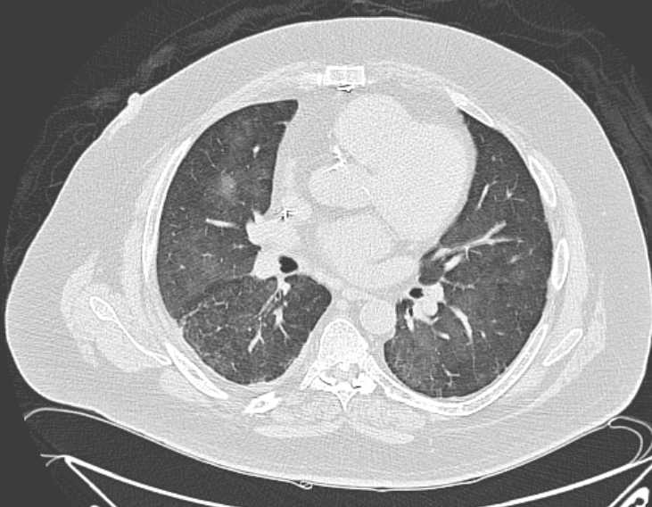 Amiodarone lung (Radiopaedia 62514-70769 Axial lung window 46).jpg