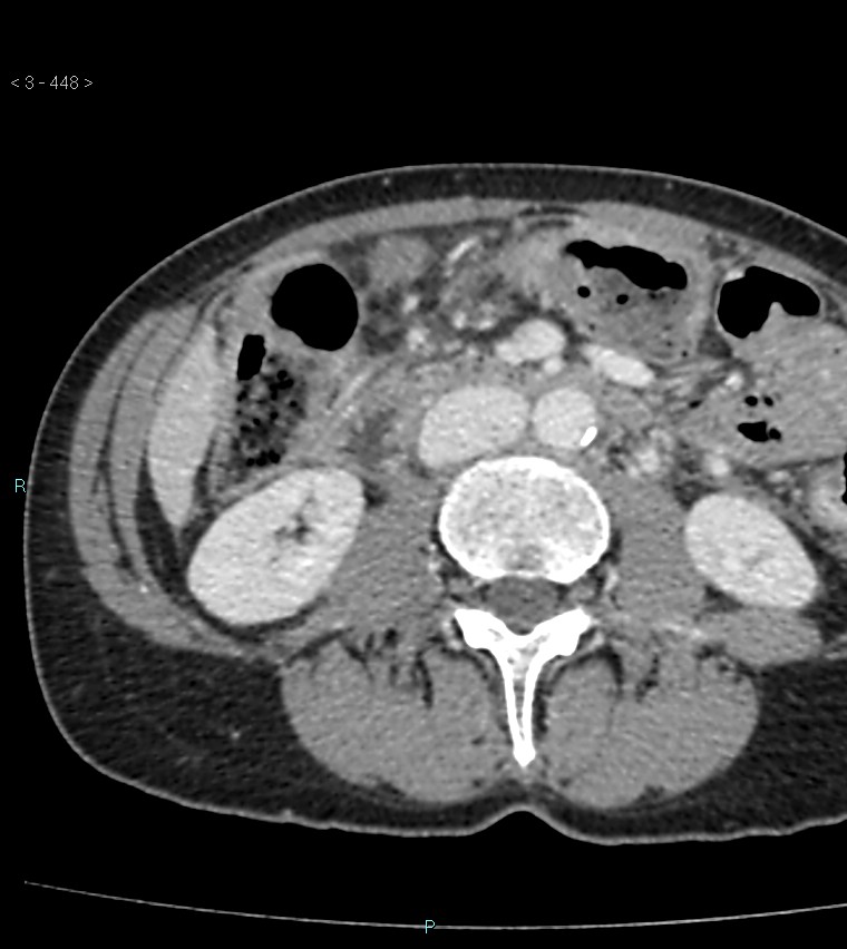 Ampulla of Vater metastasis (Radiopaedia 27820-28065 A 52).jpg