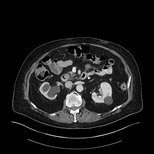 Ampullary adenocarcinoma (Radiopaedia 59373-66734 C 66).jpg