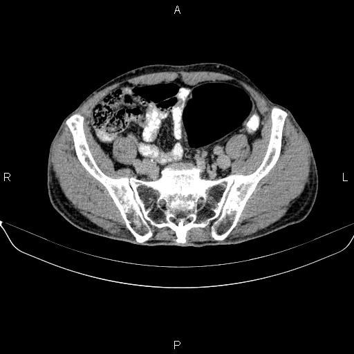 Ampullary adenocarcinoma (Radiopaedia 86093-102032 Axial C+ delayed 82).jpg