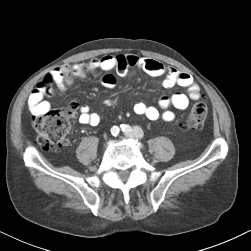 File:Amyand hernia (Radiopaedia 39300-41547 A 45).png