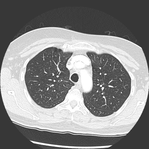 Amyloidosis - bronchial and diffuse nodular pulmonary involvement (Radiopaedia 60156-67745 Axial lung window 20).jpg