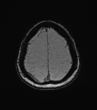 Anaplastic astrocytoma (Radiopaedia 86943-103160 Axial SWI 76).png