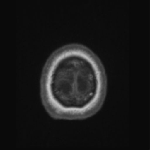 Anaplastic astrocytoma IDH wild-type (pseudoprogression) (Radiopaedia 42209-45276 Axial T1 144).png