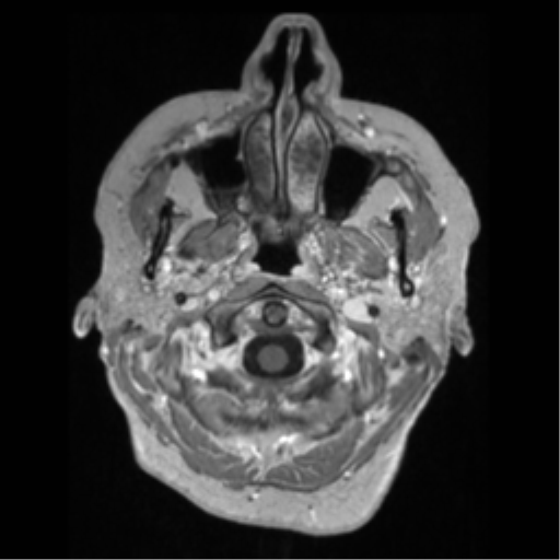 Anaplastic astrocytoma IDH wild-type (pseudoprogression) (Radiopaedia 42209-45276 Axial T1 C+ 13).png