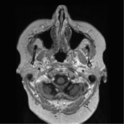 File:Anaplastic astrocytoma IDH wild-type (pseudoprogression) (Radiopaedia 42209-45278 Axial T1 C+ 22).png