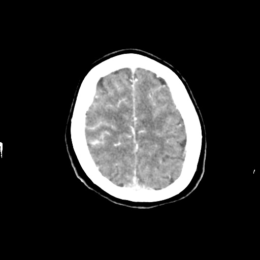File:Aneursym related subarachnoid hemorrhage with hydrocephalus (Radiopaedia 45105-49084 D 45).jpg