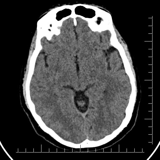 File:Aneurysm of posterior communicating artery (Radiopaedia 20188-20162 Axial non-contrast 21).jpg