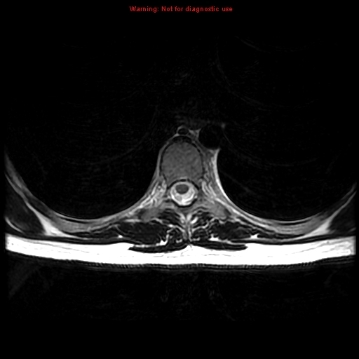File:Aneurysmal bone cyst (Radiopaedia 9419-10103 Axial T2 4).jpg