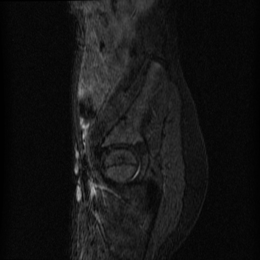 File:Aneurysmal bone cyst - sacrum (Radiopaedia 65190-74196 Sagittal STIR 27).jpg
