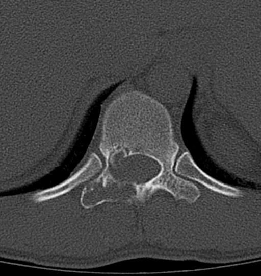 Aneurysmal bone cyst T11 (Radiopaedia 29294-29721 Axial bone window 41).jpg