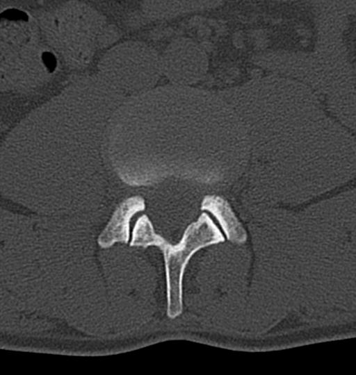 Aneurysmal bone cyst T11 (Radiopaedia 29294-29721 Axial bone window 95).jpg