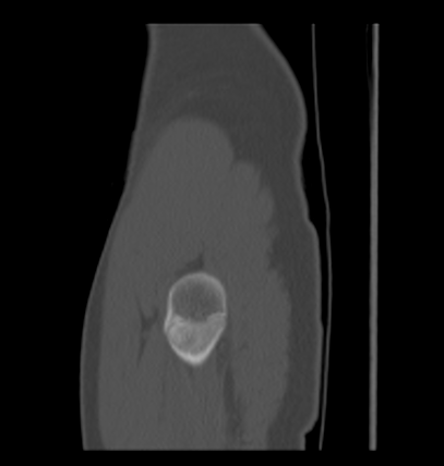 Aneurysmal bone cyst of ischium (Radiopaedia 25957-26094 Sagittal bone window 70).png