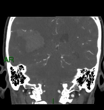 Aneurysmal subarachnoid hemorrhage with intra-axial extension (Radiopaedia 84371-99732 C 41).jpg