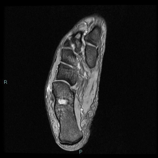 Ankle ganglion cyst (Radiopaedia 62809-71162 Axial Gradient Echo 22).jpg