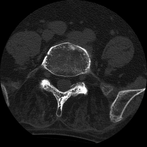 Ankylosing spondylitis complicated by fracture-dislocation (Radiopaedia 33583-34674 Axial non-contrast 130).jpg