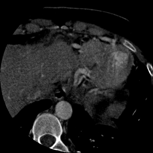 File:Anomalous left coronary artery from the pulmonary artery (ALCAPA) (Radiopaedia 40884-43586 A 78).jpg