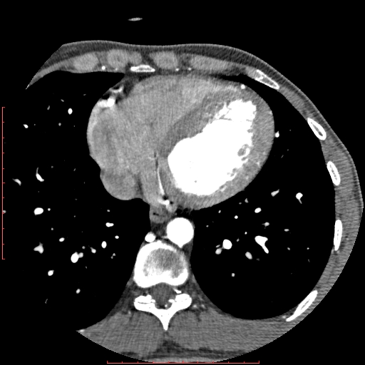 Anomalous left coronary artery from the pulmonary artery (ALCAPA) (Radiopaedia 70148-80181 A 257).jpg
