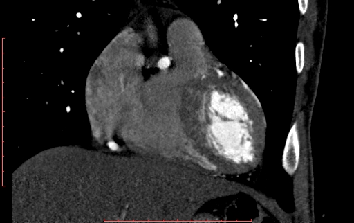 Anomalous left coronary artery from the pulmonary artery (ALCAPA) (Radiopaedia 70148-80181 B 92).jpg