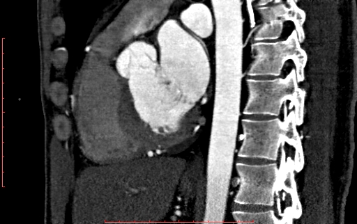Anomalous left coronary artery from the pulmonary artery (ALCAPA) (Radiopaedia 70148-80181 C 131).jpg