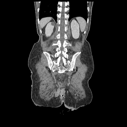 Anorectal carcinoma (Radiopaedia 44413-48064 B 72).jpg