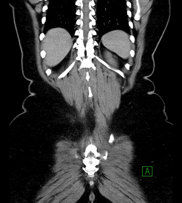 Anterior abdominal wall CSF pseudocyst (CSFoma) (Radiopaedia 79453-92571 B 47).jpg