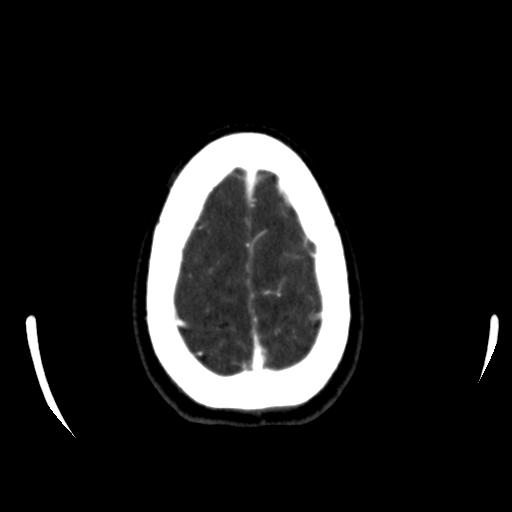 File:Anterior communicating artery aneurysm (Radiopaedia 16633-16335 A 40).jpg