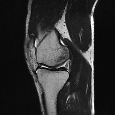 File:Anterior cruciate ligament full thickness tear (Radiopaedia 66268-75467 Sagittal T2 9).jpg