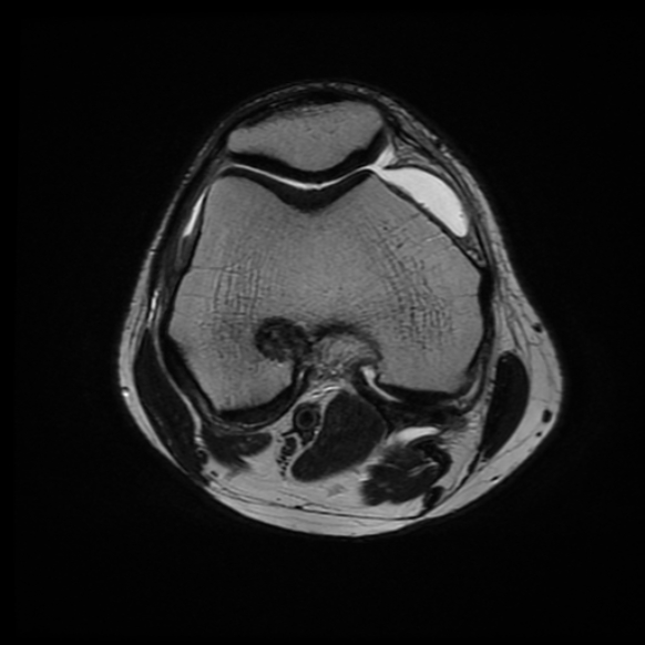 File:Anterior cruciate ligament graft tear and bucket-handle tear of medial meniscus (Radiopaedia 75867-87255 Axial T2 15).jpg