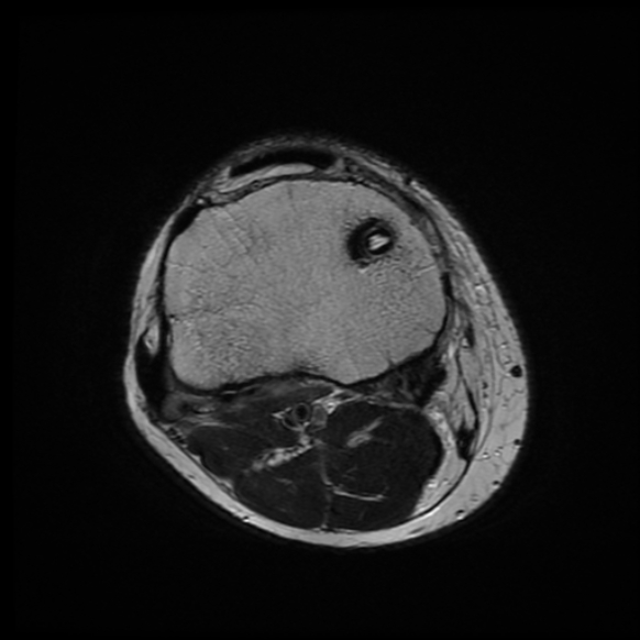 File:Anterior cruciate ligament graft tear and bucket-handle tear of medial meniscus (Radiopaedia 75867-87255 Axial T2 4).jpg