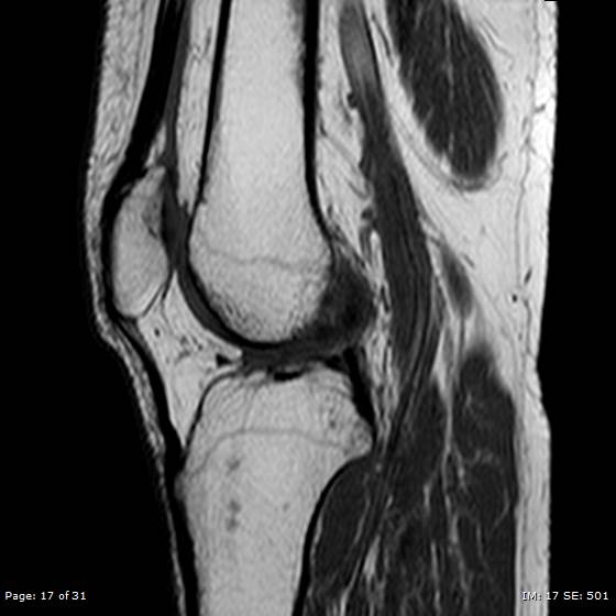 File:Anterior cruciate ligament tear (Radiopaedia 70783-80964 Sagittal T1 17).jpg