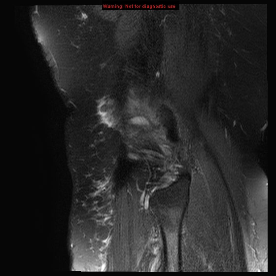 File:Anterior cruciate ligament tear - complete (Radiopaedia 12175-12514 Sagittal T2 fat sat 2).jpg