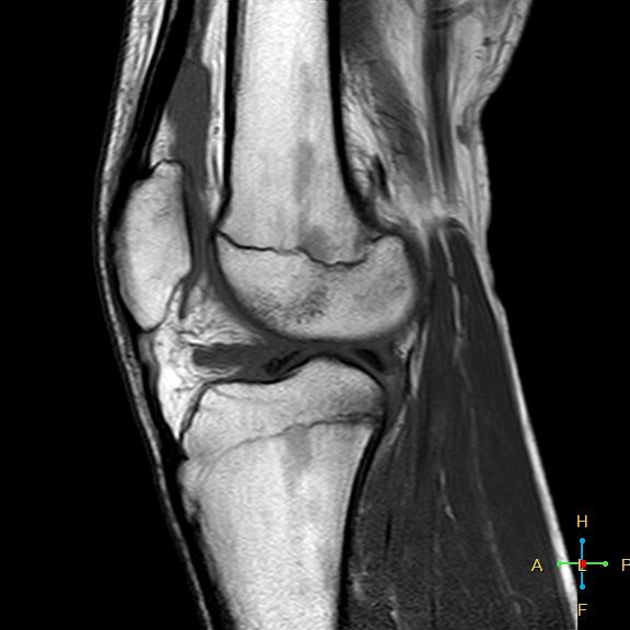 File:Anterior cruciate ligament tear - complete (Radiopaedia 24907-25170 Sagittal T1 7).jpg
