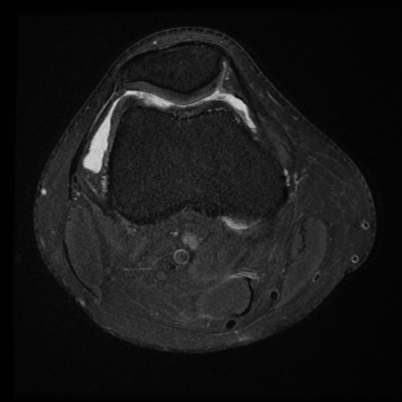 File:Anterior cruciate ligament tear with posteromedial corner injury, bucket-handle meniscal tear and chondral delamination (Radiopaedia 75501-86744 Axial PD fat sat 20).jpg