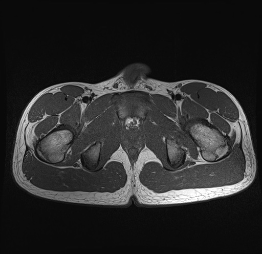 File:Anterior inferior iliac spine avulsion fracture (Radiopaedia 81312-95000 Axial T1 8).jpg