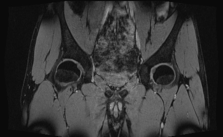 Anterior inferior iliac spine avulsion fracture (Radiopaedia 81312-95000 G 56).jpg