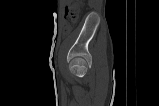 Anterior inferior iliac spine avulsion injury (Radiopaedia 88666-105376 Sagittal bone window 28).jpg