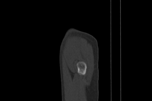 Anterior inferior iliac spine avulsion injury (Radiopaedia 88666-105376 Sagittal bone window 95).jpg