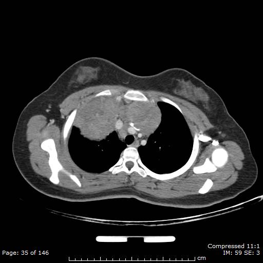 File:Anterior mediastinal B cell Lymphoma (Radiopaedia 50677-56114 A 18).jpg
